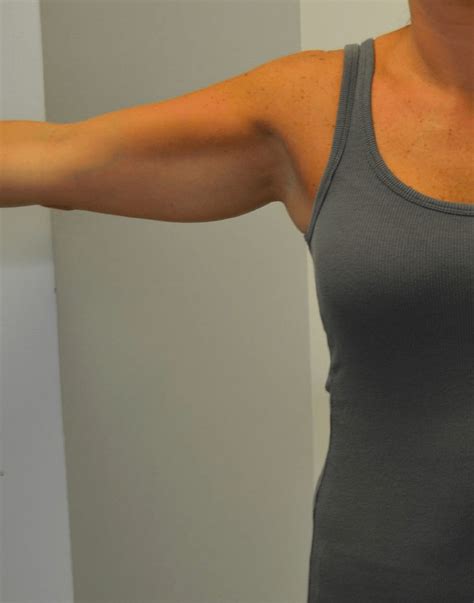 CoolSculpting® (Cryolipolysis) Overview: Cost, Recovery, Before & After.